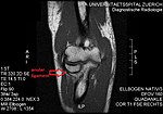 MRI. Unimpaired anular ligament..jpg