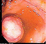 Endoscopic image of polyp in small bowel detected on double-balloon enteroscopy SB polyp.jpg