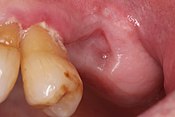 clinical photograph of a well healed socket