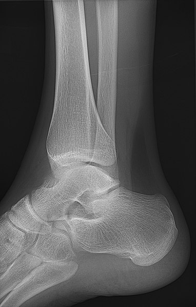 File:X-ray of normal ankle - lateral oblique.jpg