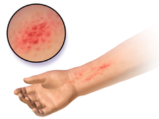 Blaŭsen 0014 AllergicDermatitis.png