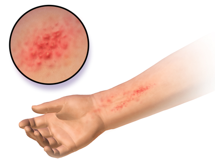 Illustration of allergic contact dermatitis
