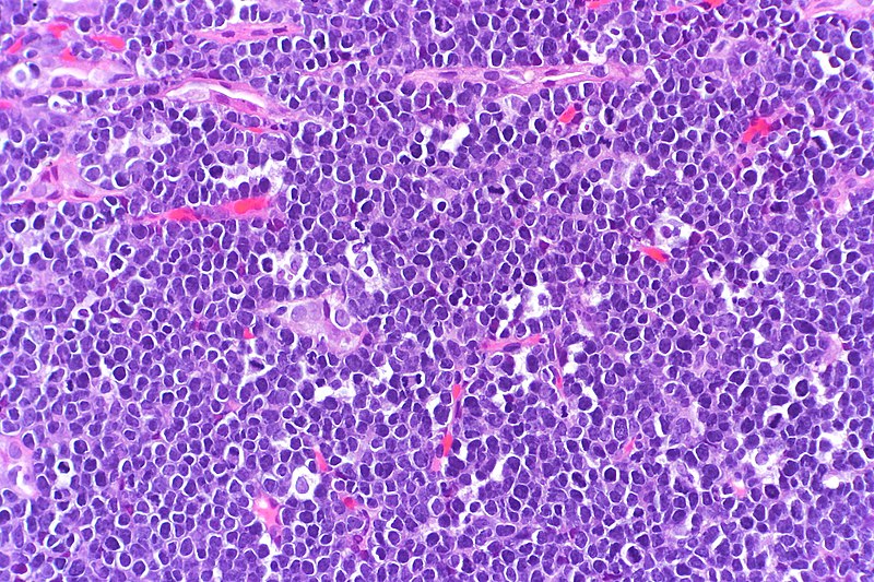 File:Burkitt's lymphoma in a kidney biopsy, very high mag.jpg