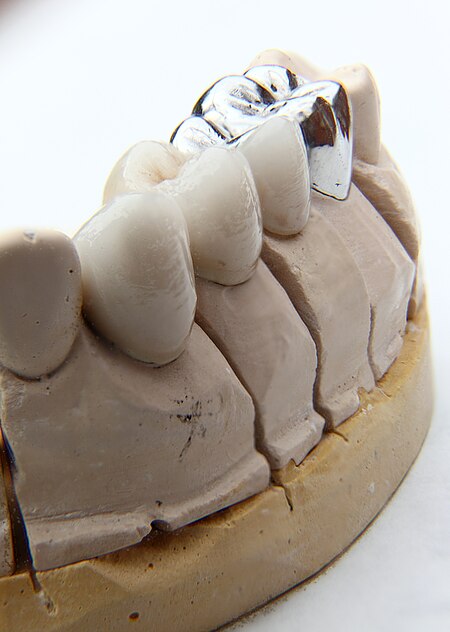 Fail:Dental bridge Focus stacking Result with CombineZP Soft stacking 2012.jpg