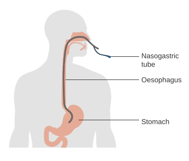 File:Diagram showing the position of a nasogastric tube CRUK 340.svg