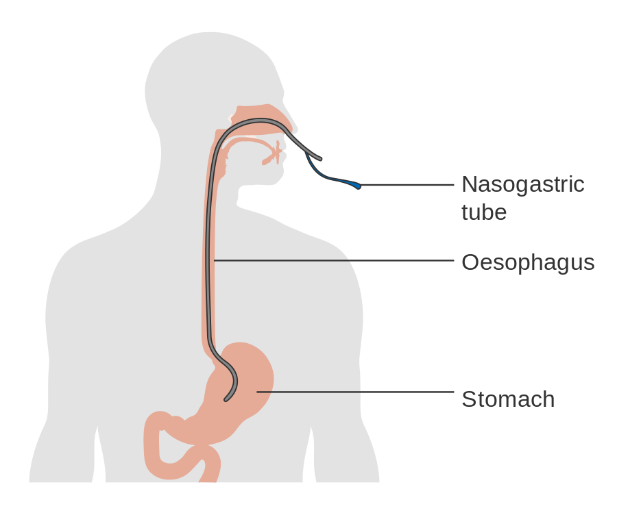 Ilustración de sonda nasogástrica.Helicobacter pylori, Biología, medicina.  úlcera peptica.