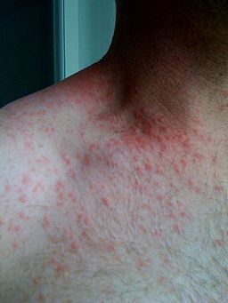 Folliculitis-1