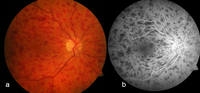 Miniatuur voor Occlusie van de vena centralis retinae