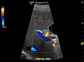 Hepatofugal flow in portal vein in ultrasound