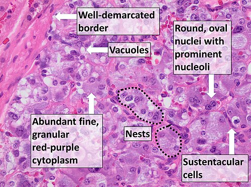 Histopathology on the resected tumour confirms the diagnosis by typical features.
