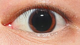 The pupil widens when the iris dilator muscle is stimulated and contracts. An extreme, though natural, case is shown Human eye in dim light.jpg