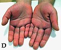 Erythema and tough swelling of hands and feet + swelling of PIP hand joints