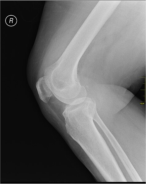 File:Medical X-Ray imaging OFS06 nevit.jpg
