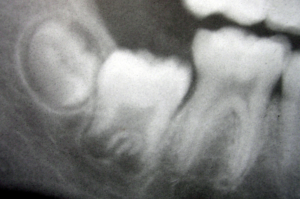 initial calcification of permanent teeth