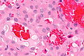 PTC oncocytic - very high mag.