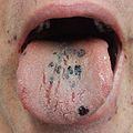 Петехија на јазик кај личност со тромбоцити од 3 поради ИТП