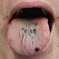 Petechia on the tongue in a person with platelets of 3 due to ITP