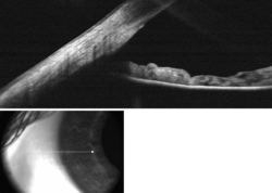 SD OCT - Anterior Chamber Angle Cross-Section (with viewfinder).png