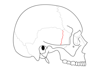 <span class="mw-page-title-main">Sphenosquamosal suture</span> Cranial suture between the sphenoid bone and the squama of the temporal bone