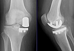 Thumbnail for Unicompartmental knee arthroplasty