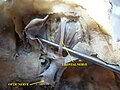 Frontal nerve.Deep dissection.Superior view