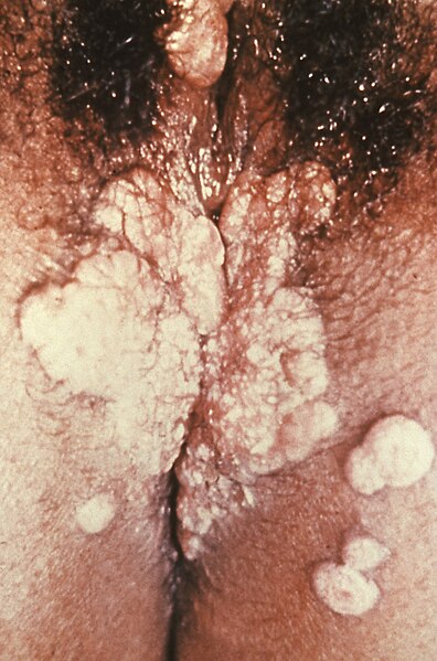 File:Vaginal syphilis (disturbing image).jpg