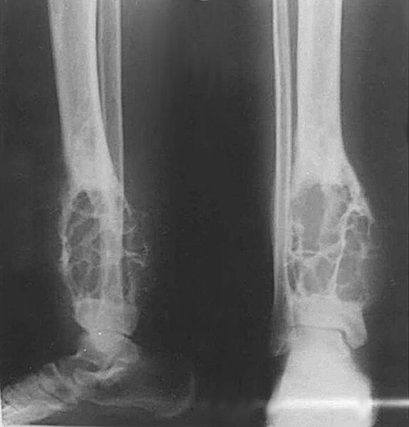 File:X-ray of adamantinoma of the tibia.jpg