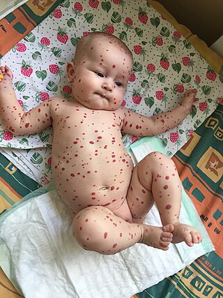 <span class="mw-page-title-main">Benign neonatal hemangiomatosis</span> Medical condition in infants with multiple skin hemangiomas
