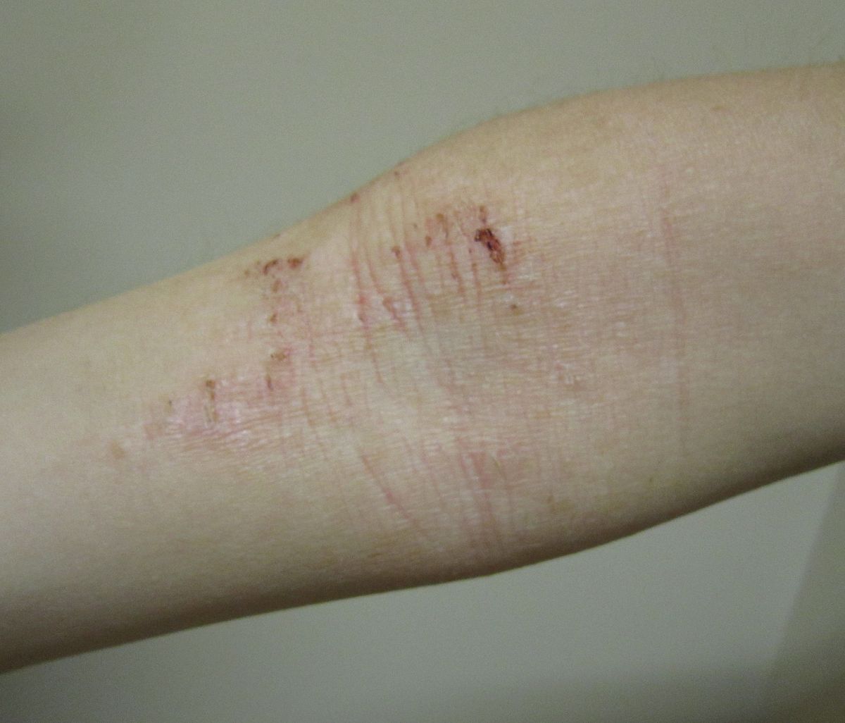 atopic dermatitis pictures vélemények a pikkelysmr kezelsrl
