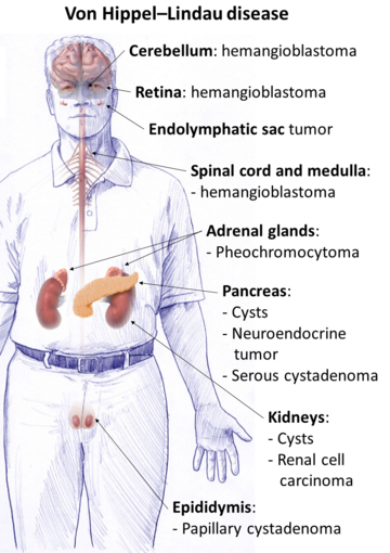 Von Hippel–Lindau disease