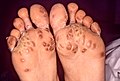 Keratoderma blennorrhagicum dans le syndrome de Reiter