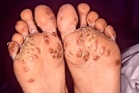 Feet-Reiters syndrome.jpg