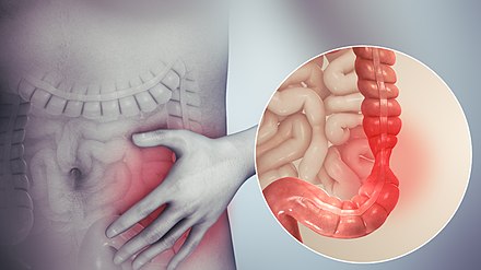 3d depiction of the pain of IBS
