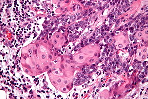 NUT midline carcinoma - много висока mag.jpg