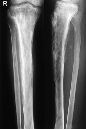 Paget-Tibia.jpg