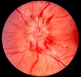 Фотография глазного дна показывает тяжёлый отёк зрительного нерва в левом глазе