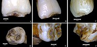 Thumbnail for Plane-form enamel hypoplasia