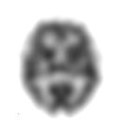 Ein SPECT Schnitt der Verteilung von 99m-Tc Ceretec im Hirn eines Patienten.