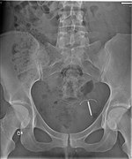 X-ray of abdomen with perforated IUD.jpg