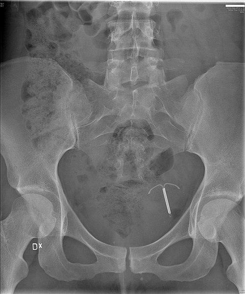 File:X-ray of abdomen with perforated IUD.jpg