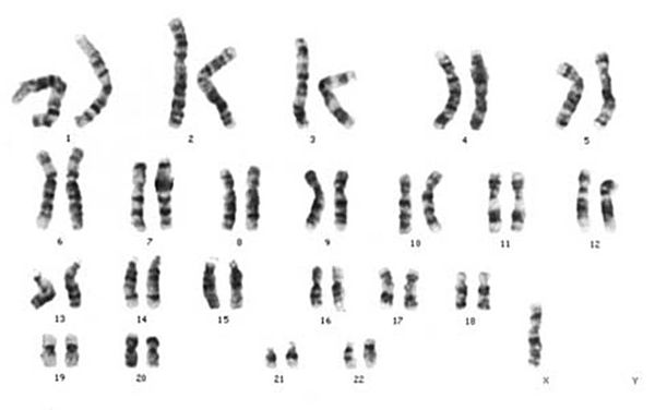45 хромосом. Синдром Марфана кариотип. Миодистрофия Дюшенна кариотип. Синдром Орбели кариотип.