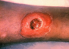 A diphtheria skin lesion on the leg. PHIL 1941 lores.jpg