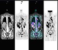 Abnormal whole body PET/CT scan with multiple metastases from a cancer. The whole body PET/CT scan has become an important tool in the evaluation of cancer.