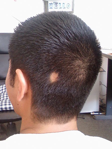 File:Alopecia areata bald spot.jpg