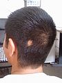 Alopecia areata bald spot.jpg