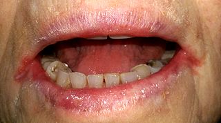 <span class="mw-page-title-main">Angular cheilitis</span> Cheilitis characterized by inflammation of one or both of the corners of the mouth