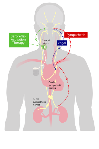 <span class="mw-page-title-main">Baroreflex activation therapy</span>