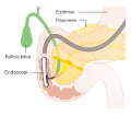 Miniatura per Colangiopancreatografia retrògrada endoscòpica