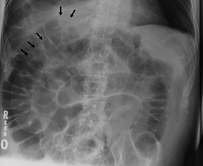 Double wall sign. This is a secondary sign of pneumoperitoneum. Patient is supine, and air within the abdomen and lumen of the bowel accentuate both sides of the bowel wall.