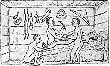 A caesarean section performed by indigenous healers in Kahura, in the Empire of Kitara (present-day Uganda) as observed by medical missionary Robert William Felkin in 1879. Drawing showing a caesarean operation taking place in Uganda Wellcome M0001058.jpg